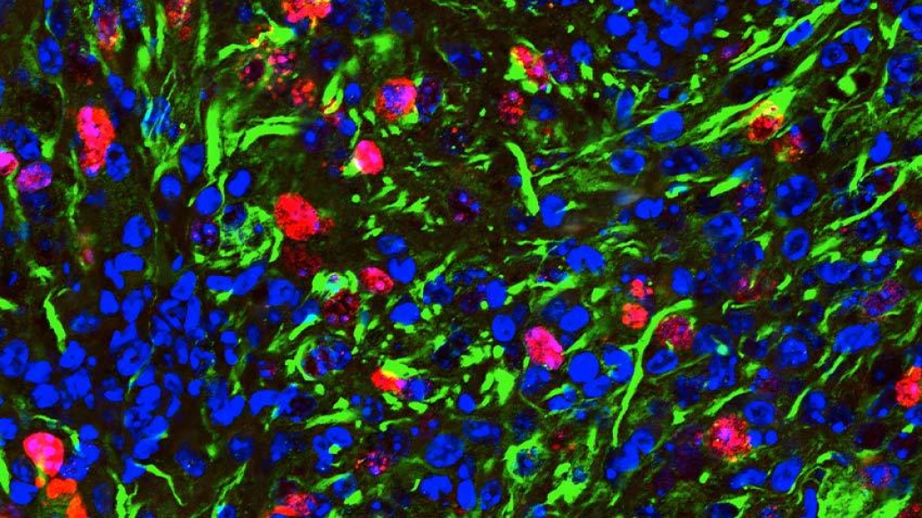 Glioma scientific rendering cancer cells