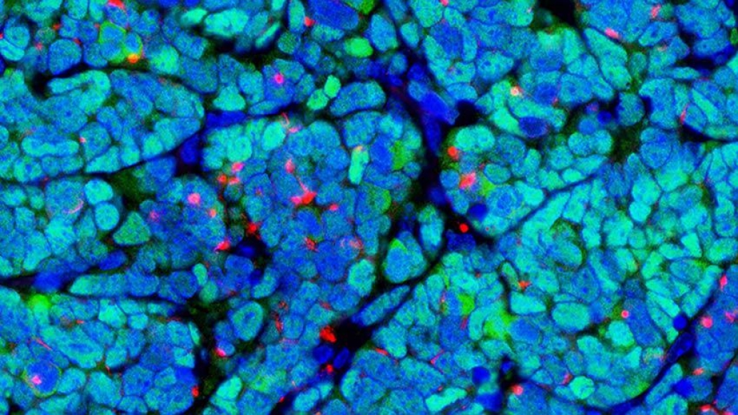 microscopic tumor cellular blue green