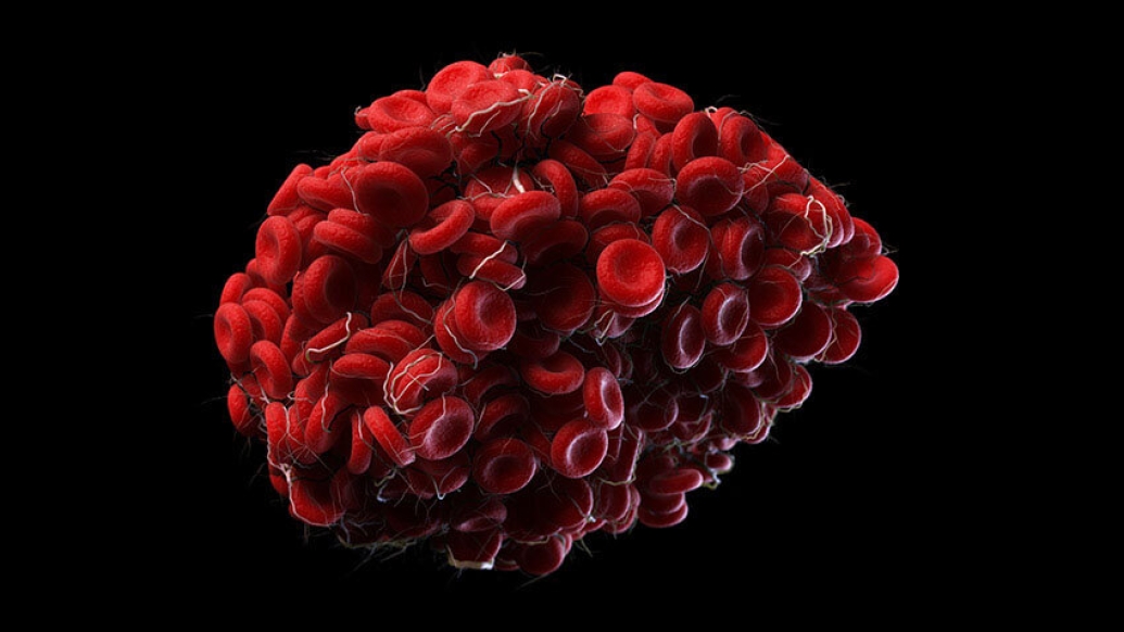 Image of a blood clot
