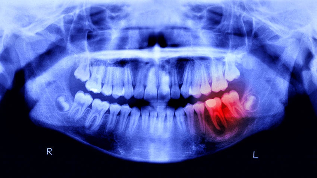 dental xray with red spot noting infection