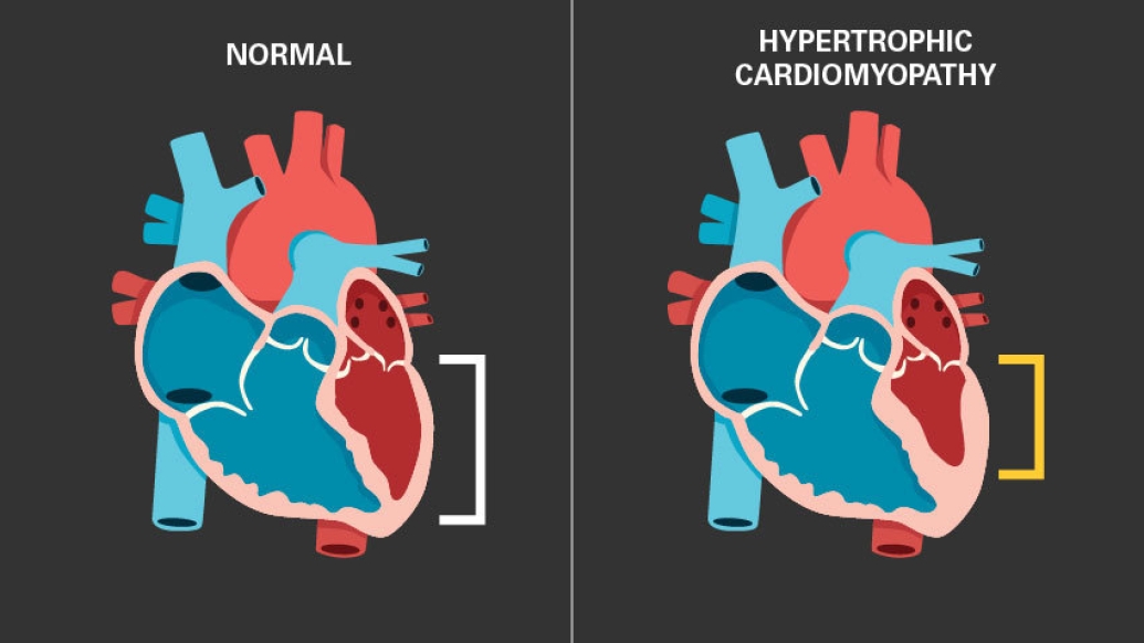 hypertrophic cardiomyopathy and normal heart image in blue and red