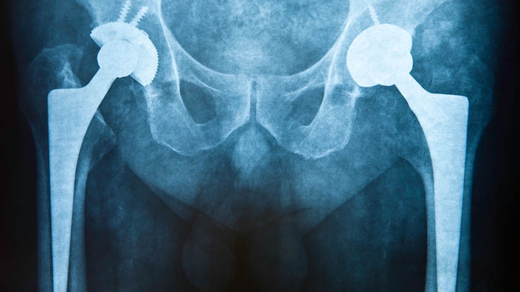 x-ray of hips
